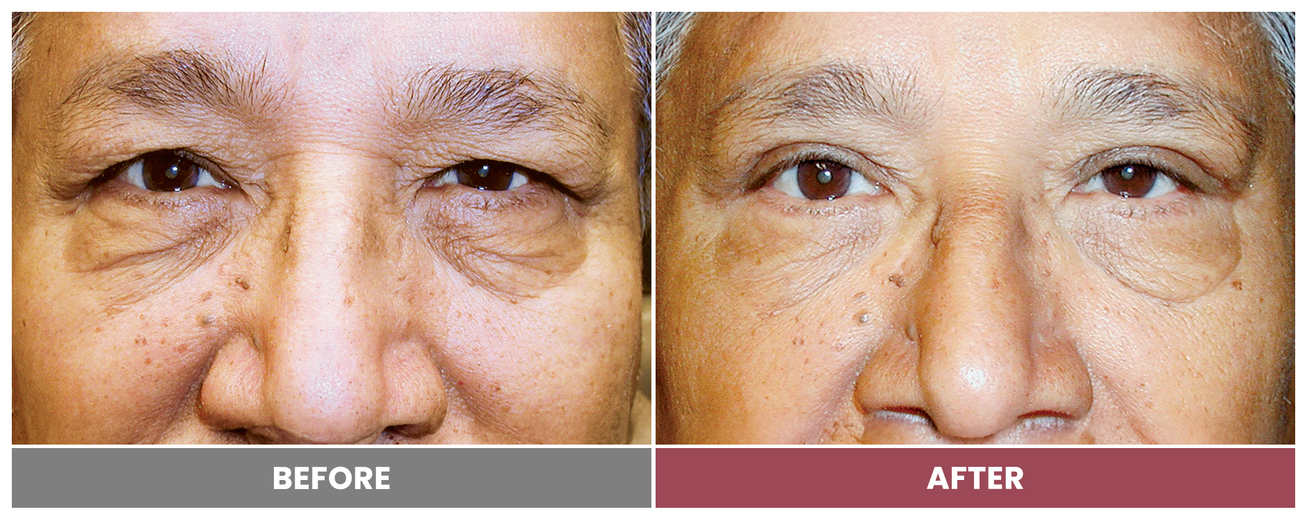 Upper Blepharoplasty - Case 102